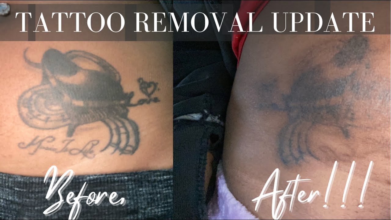 Tattoo Removal Update| Cost, PAIN, Full Details|Laser Tattoo Removal| Before & After| Sessions 1-4