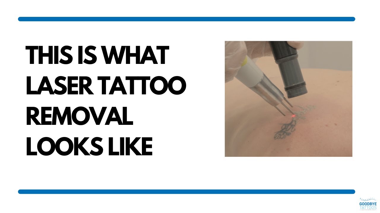 This Is What Laser Tattoo Removal Looks Like