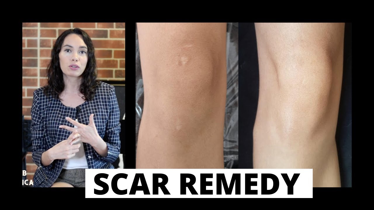 WHAT KINDS OF SCARS CAN BE CAMOUFLAGED? Scar Camouflage tattoo explained. (Paramedical Tattoo)